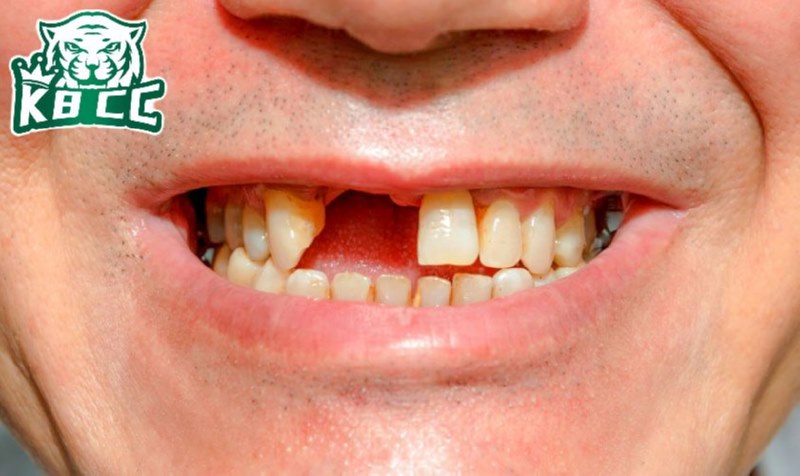 Giấc mơ gãy răng báo hiệu điều gì? Giải mã ý nghĩa chi tiết Mơ gãy răng cửa trên báo hiệu bạn phải cẩn trọng