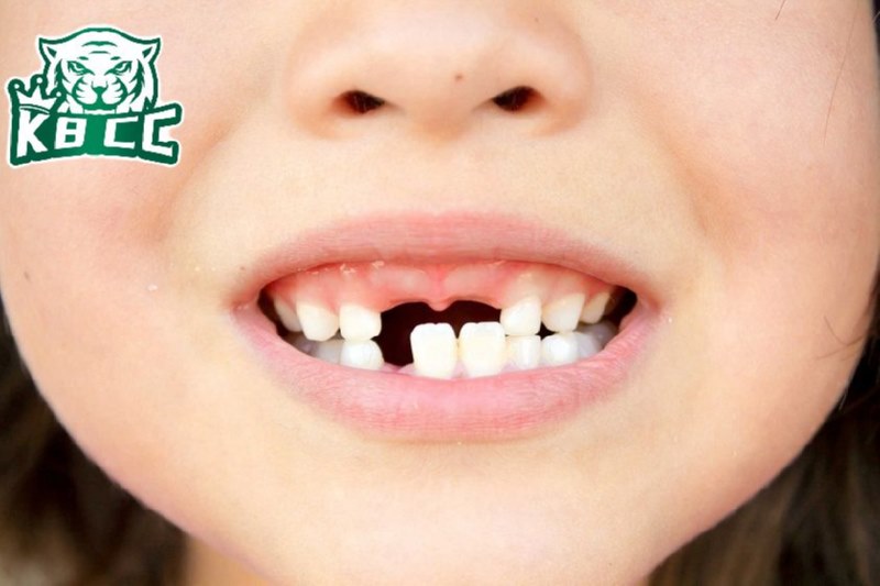 Giấc mơ gãy răng báo hiệu điều gì? Giải mã ý nghĩa chi tiết giac mo gay rang